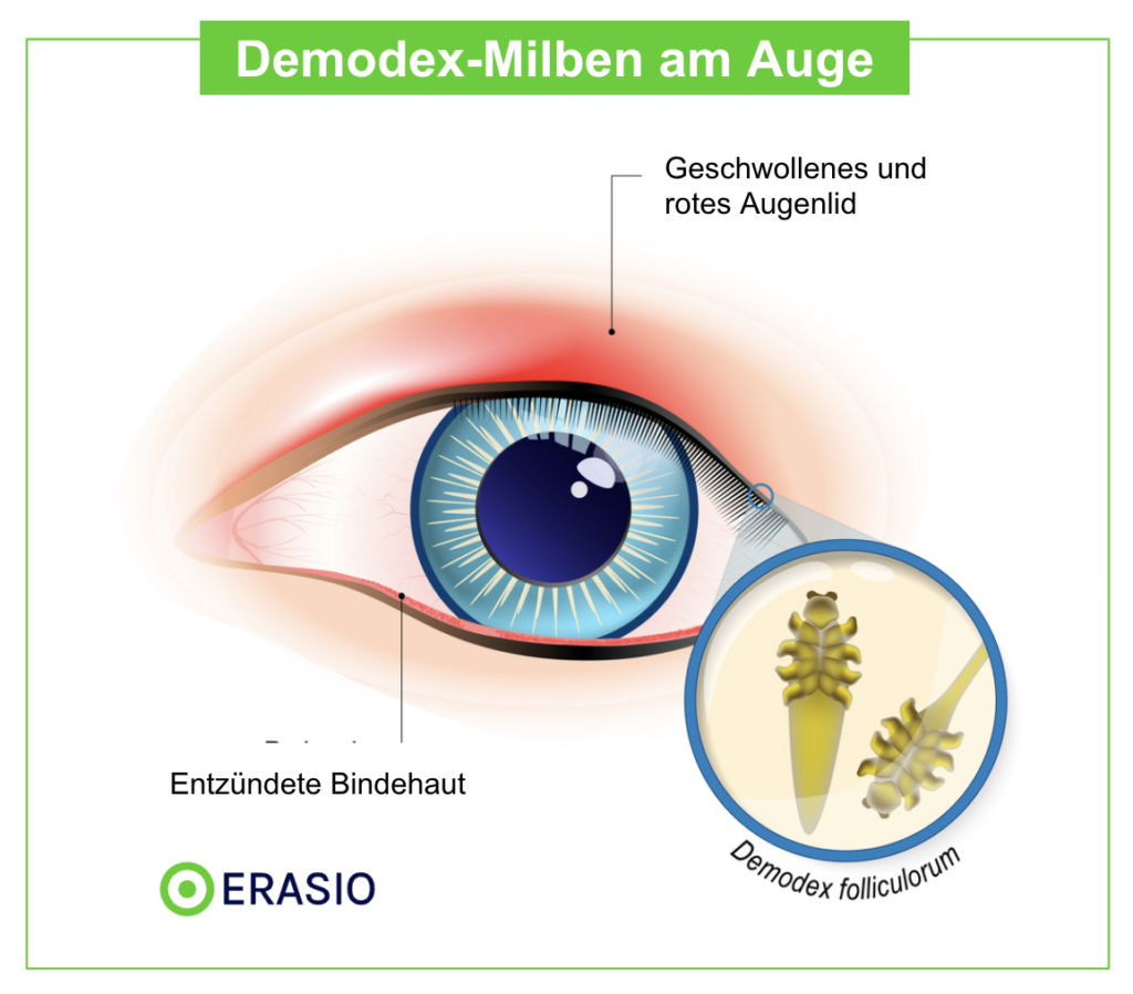 Demodex-Milben am Auge