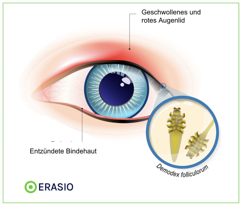 Demodex-Milben Bisse