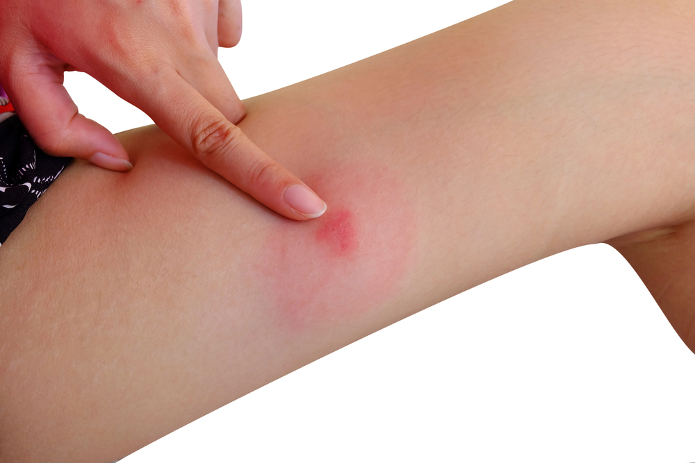 Kriebelmückenstich auf dem Arm