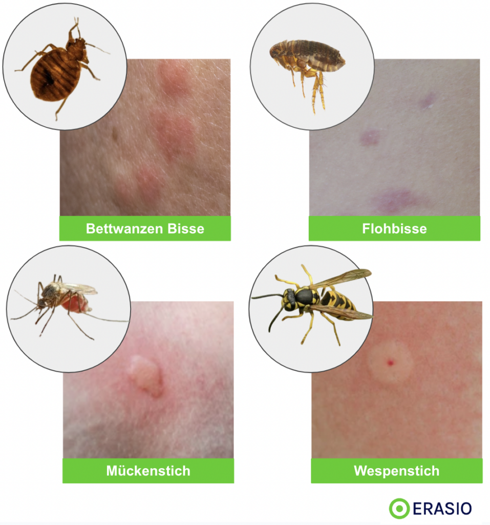 Bettwanzenbisse im vergleich zu Flohstich und Mückenstich