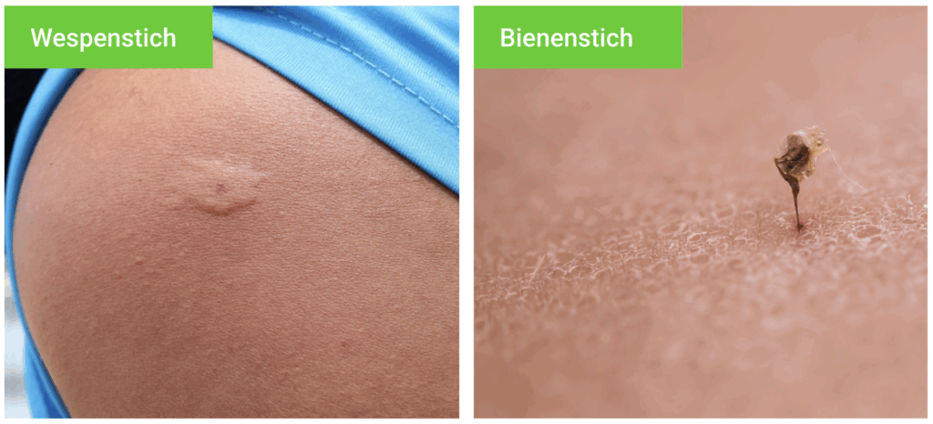Unterschied zwischen einem Bienenstich und einem Wespenstich